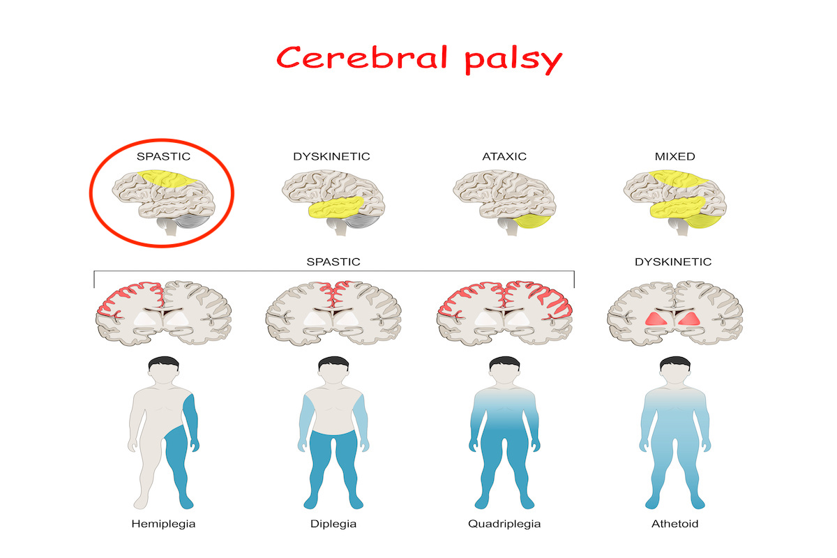 Cerebral Palsy Brain