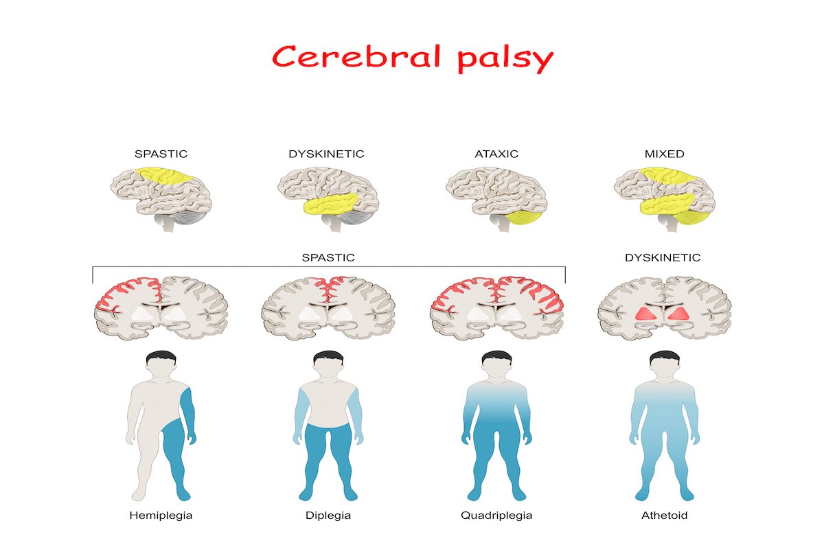 Types Of Cerebral Palsy